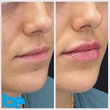 lip injections in lexington ky