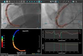Image Based Ffr May Replace Pressure Wires And Adenosine Daic