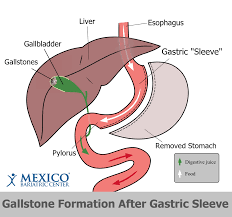 gallstones after weight loss surgery