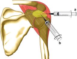This disease comes in over 100 different forms and is treated in various ways, one of which is through injections. Shoulder Injection And Needling Therapy Springerlink