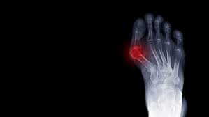 We did not find results for: Bunions X Ray Foot Pain When To See A Doctor Orthocarolina