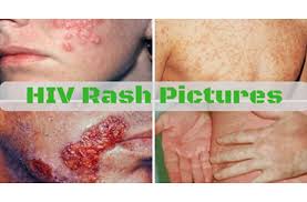 hiv skin rash
