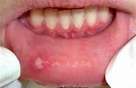 top 5 tips for mouth ulcers home