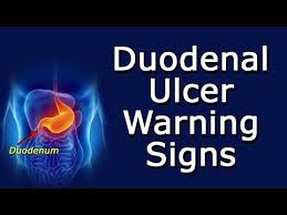 duodenal ulcer warning signs you