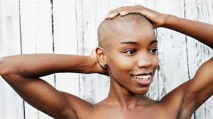 Alopecia areata is believed to be an autoimmune disease resulting from a breach in the immune privilege of the hair follicles. 5 Things I Learned About Alopecia On My Hair Growth Journey Essence