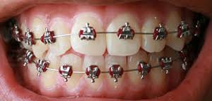 Orthodontic Archwire Wikipedia