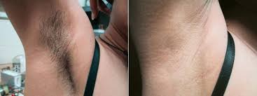 underarms and hands laser hair removal