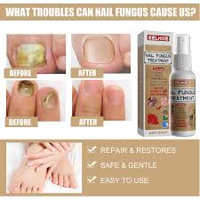 toe funguses nail treatment extra