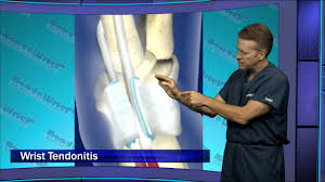 Wrist injuries in tennis players, even elite/professional players, are common. Hawtv Ep 2 Tennis Wrist Injuries And Prevention Youtube
