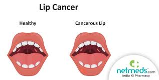 lip cancer causes symptoms and treatment