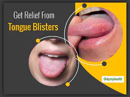 have blisters on tongue treat them