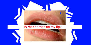 is that herpes on my lip herpes
