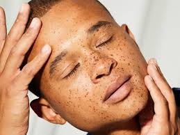 what to know about freckles and how to