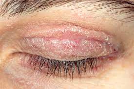 eczema on eyelid stock image c021