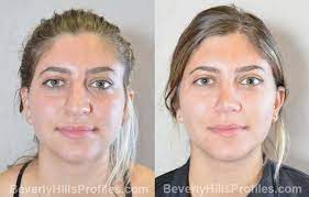Maybe you would like to learn more about one of these? Rhinoplasty Before After Photos At Beverly Hills Profiles