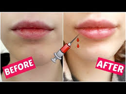 I Got Lip Injections Experience Price Pain Etc