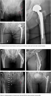 proximal femur fractures in the elderly