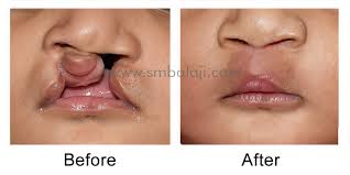 correction of bilateral cleft lip