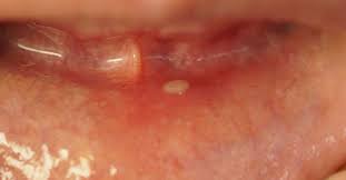 white spots and sores on gums causes
