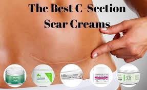 Procedure, reasons, recovery, and complications. The Ultimate Guide To The Best C Section Scar Creams The Baby Swag