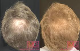 hair loss caused by stress losing hair