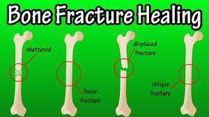 bone fracture healing process