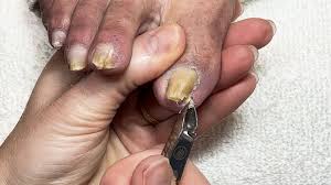 how to help thick yellow toenails at