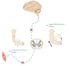symptoms of motor neuron diseases