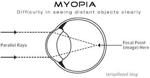 Myopia What Does Actually Mean Tariq Al Fayad Blog