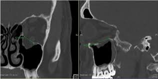 orbital floor fractures epidemiology