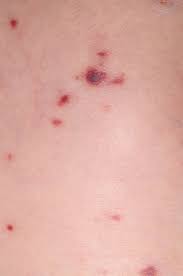 Purpura, known as purple spots or patches on the skin, is caused by small blood vessels leaking under the skin. Purpuric And Petechial Rashes In Adults And Children Initial Assessment The Bmj