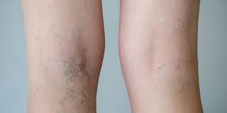 want to get rid of spider veins now