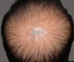stem cell hair loss treatment clinic