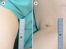 right inguinal lymph node swelling and