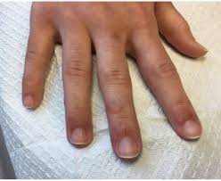 erythematous pas on her fingers