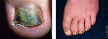 effective treatments for toenail fungus
