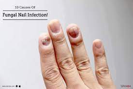 10 causes of fungal nail infection