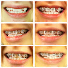 Can braces provoke appearance of teeth pain? Pin On Beauty
