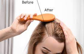 how to combat thyroid induced hair loss
