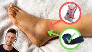 acute ankle sprain