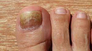 nail eczema and nail psoriasis