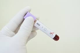 Resultado de imagem para imagem exame hiv