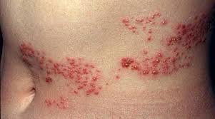 What is Herpes Zoster? Causes Symptoms and Treatment