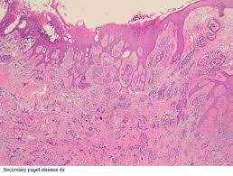Chemotherapy, radiation therapy, hormonal therapies, complementary therapies are the major therapies used in the treatment of paget's afsar rahbar studies of the importance of cytomegalovirus infection in breast cancer ppt version | pdf version. Pathology Outlines Paget Disease