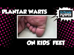 plantar warts on my kids feet you