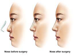 Nose (Rhinoplasty) - Conditions & TreatmentsSingHealth