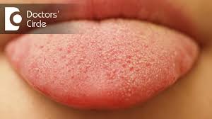 what causes small red patches on tongue