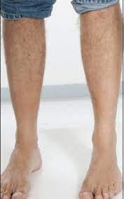 The causes of leg hair loss are numerous. Leg Hair Loss In Men It S Not Uncommon Hubpages
