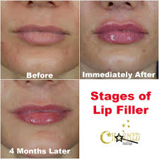 ses of lip injections and what to