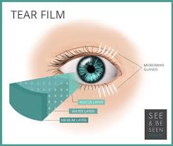 ipl for meibomian gland dysfunction